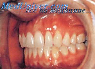 нарушения прикуса