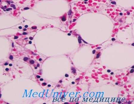 патогенез апластической анемии