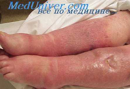 гнойная инфекция