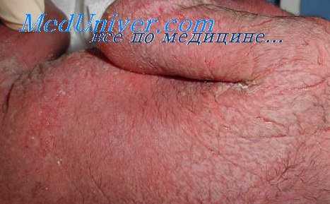 причины сепсиса