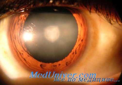 катаракта от тринитротолуола - тнт