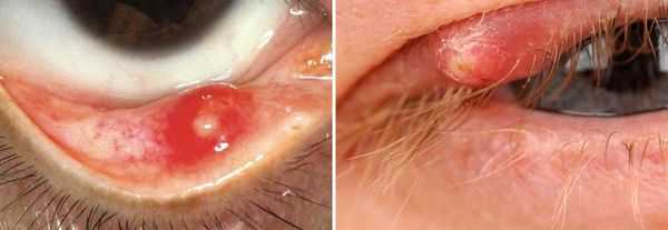 Внутренний и наружный ячмень