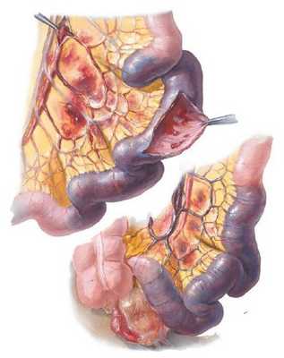 Мезентериальный тромбоз с некрозом кишки