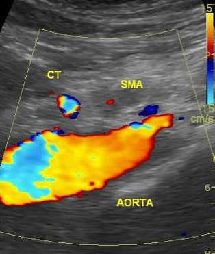 УЗИ картина закупорки верхней брыжеечной артерии