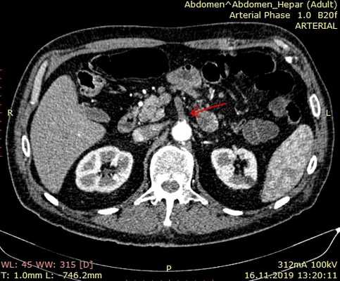 МСКТ ангиография при остром тромбозе верхней брыжеечной артерии