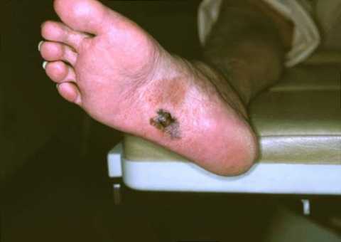 меланома стопы