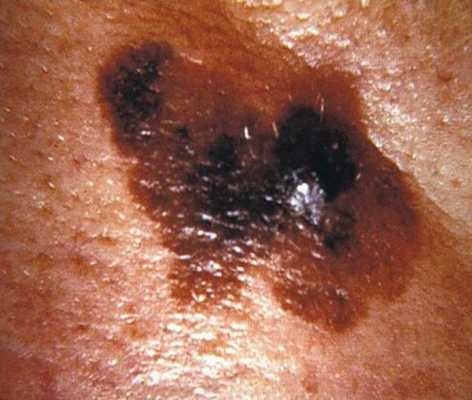 меланома кожи