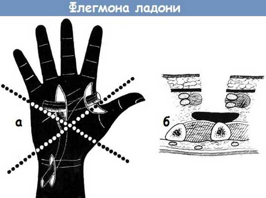 Флегмоны ладони