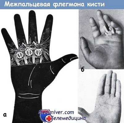 Межпальцевая флегмона кисти