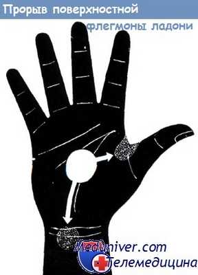 Места прорыва поверхностной флегмоны ладони