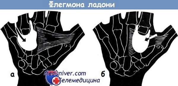 Флегмоны ладони