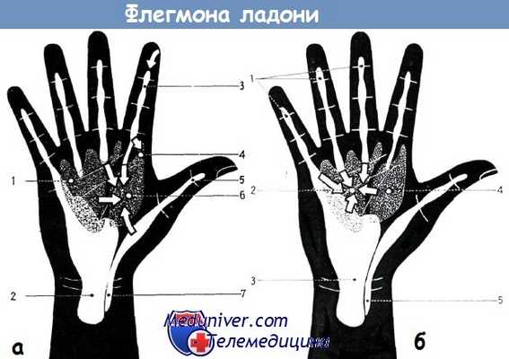 Флегмоны ладони