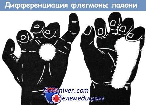 Дифференциация флегмоны ладони