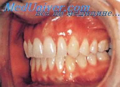 аномалии прикуса