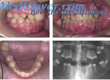 буккальный прикус