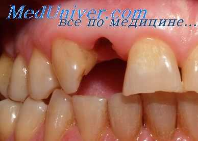 аномалии прикуса