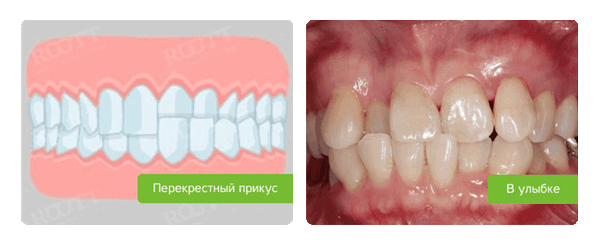 перекрестная окклюзия