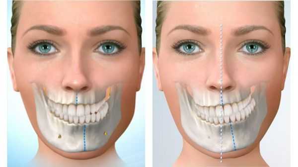 Сдвиг челюсти при перекрёстном прикусе