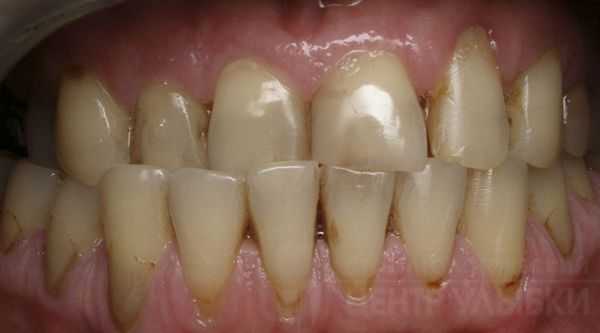 Клиновидные дефекты, сколы эмали и стираемость зубов при перекрёстном прикусе