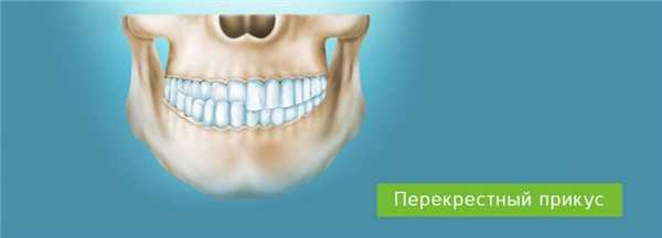 Перекрестный прикус