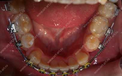 Лечение с удалением нижних премоляров