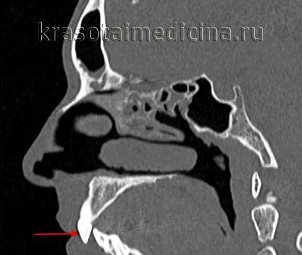 Мезиальный прикус