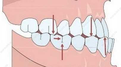 Выступающая нижняя челюсть