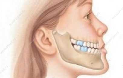 Лицевые признаки мезиальной окклюзии