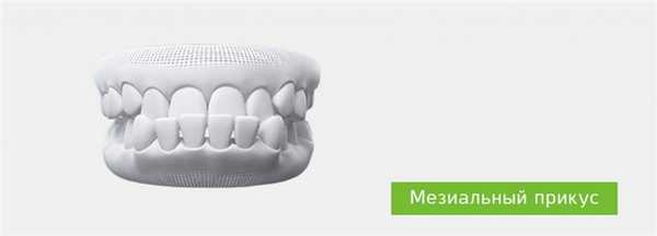 Мезиальный прикус