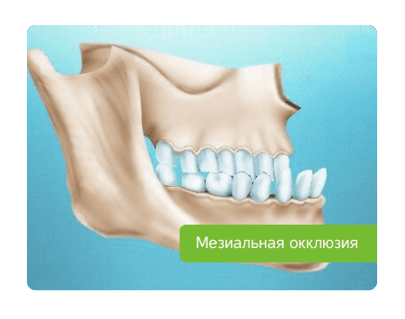 мезиальная челюсть