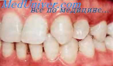 Аномалии положения зубов