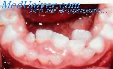 Аномалии положения зубов