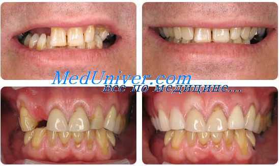 мезиальное положение зубов