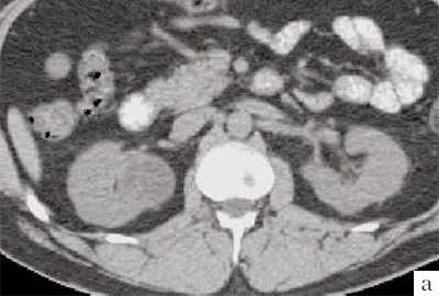 КТ - кистозное образование правой почки, до контрастирования пределяется негомогенное образование неправильной округлой формы с капсулой и едва заметными перегородками, плотность ниже, чем плотность паренхимы почки