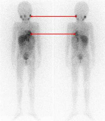Рис. 7. Сцинтиграфия с метайодбензилгуанидином (визуализируется первичная паравертебральная опухоль с метастазами в кости черепа)