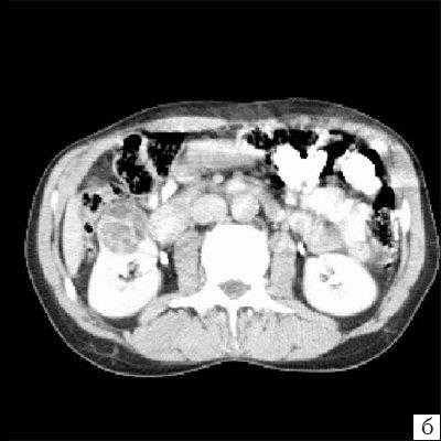 КТ - кистозное образование правой почки, после контрастирования (паренхиматозная фаза) отчетливо выявляются плотная стенка и множество перегородок