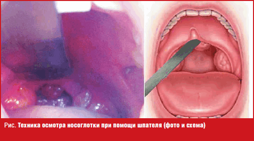 Техника осмотра носоглотки при помощи шпателя