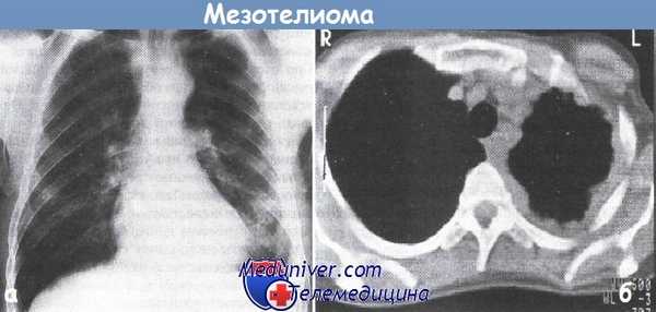 Диагностика мезотелиомы