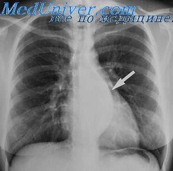 Рентгенография в прямой проекции при невриноме средостения
