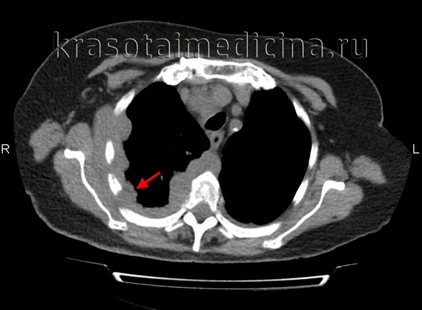КТ органов грудной клетки. Мягкотканное утолщение плевры справа с наличием узлового поражения
