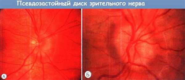 Псевдозастойный диск зрительного нерва