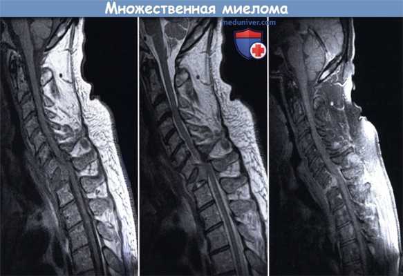 МРТ при множественной миеломе позвоночника
