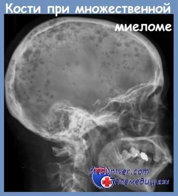 Кости при множественной миеломе