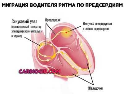 миграция водителя ритма в левое предсердие