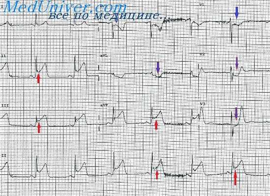 атриовентрикулярный ритм