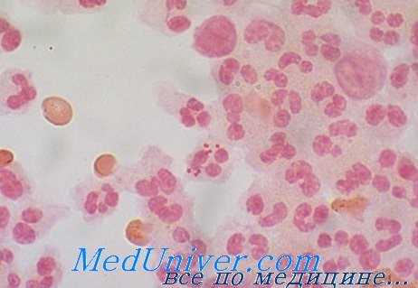 возбудитель менингита - Neisseria meningitidis