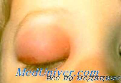 эффективность лечения эндофтальмита