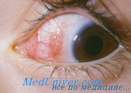 микробиология ранений глазного яблока