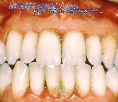 пародонтит