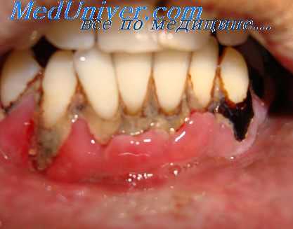 зубные бляшки